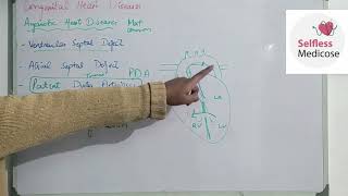 FCPS part 1CVS lecture 20 ACYANOTIC HEART DISEASES made easy [upl. by Yrnehnhoj]