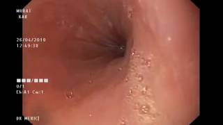 EGD  esophagogastroduodenoscopy [upl. by Yhtorod]