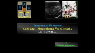 Ultrasound Case 222  Mineralizing Vasculopathy  TORCH [upl. by Charmain149]