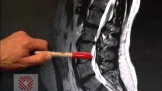 Low Back Pain Part 8 Spinal Stenosis [upl. by Carin]