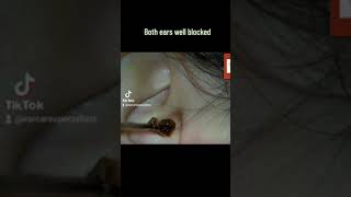 Both ears blocked with wax satisfying extraction ear earwax earcarespecialists audiology [upl. by Shulins14]