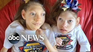 Kansas Parents of 2 Girls With Microcephaly Share Joys Struggles of Family Life [upl. by Idur]