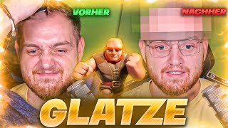 😨🤯GLATZE LIVE RASIERT  HAARTRANSPLANTATION INCOMING [upl. by Melany]