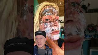 SHOCKING CO2 Laser Recovery Is Normal  Plastic Surgeon Reacts [upl. by Alejo198]