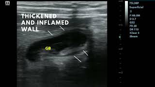 Cholecystitis [upl. by Maurizia278]