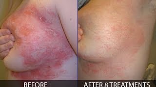 How to treat psoriasis effectively  By Franziska Ringpfeil Board Certified Dermatologist [upl. by Issirk]