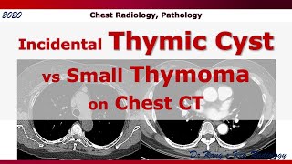 Incidental Thymic Cyst vs Small Thymoma CT [upl. by Davide]