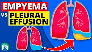 Empyema vs Pleural Effusion EXPLAINED [upl. by Nuhsed169]