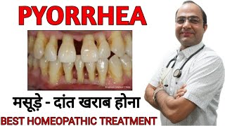 Pyorrhoea । जिंजिवायटिस । gingivitis । gums ।हैलिटोसिस [upl. by Le]