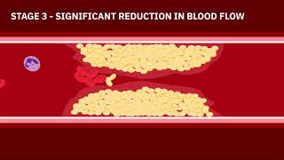 Coronary Artery Disease Animation [upl. by Asira]