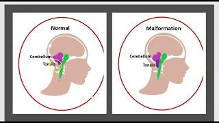 La Syringomyélie Malformation dArdnold Chiari LHydrocéphalie Maladie du Filum Syrinx Traitement 3m [upl. by Sou]