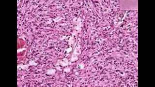 Histopathology DiaphragmMetastatic liposarcoma [upl. by Yspyg]