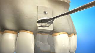 Bone Grafting Procedure Video Animation  Durham Dental Solutions [upl. by Thecla]