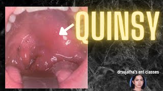 168Peritonsillar abscess Quinsy sorethroat tonsillitis abscess [upl. by Aalst]