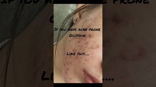 How to clear acne  Pimples  and  Get Clear Skin skincare acneskincareroutineacneclearviral [upl. by Lyrpa]