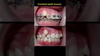 Crooked teeth braces [upl. by Sacrod661]