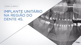 Caso Clínico Implante unitário na região dente 45 [upl. by Yar]