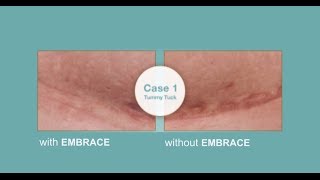 Embrace™ Silicone Tape vs Traditional Scar Treatments [upl. by Tica]