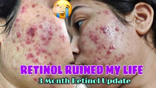 RETINOL SIDE EFFECTS MY 3 MONTH ACNE JOURNEY RETINOL BEFORE amp AFTERRETINOL JOURNEY [upl. by Anailuy]