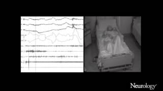 Immunotherapy of oneiric stupor in Morvan syndrome Efficacy documented by actigraphy [upl. by Hiram304]