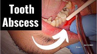 Incision and Drainage of Tooth Abscess Draining Pus [upl. by Legge291]