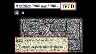 ECG Video2 Blog 96  BBB 83012014 [upl. by Pelaga893]