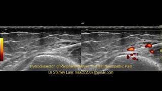 Ultrasound Guided Hydrodissection of Obturator Nerve and Saphenous Nerve at the Adductor Tubercle [upl. by Meier261]