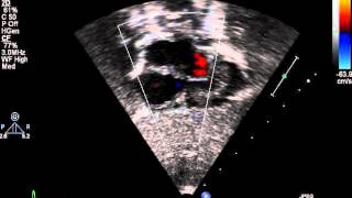 Subcostal 4 chamber view 2D with color [upl. by Avruch]