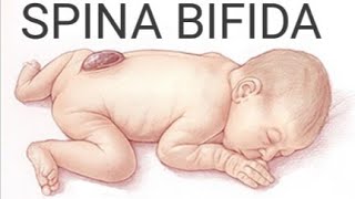 Spina Bifida  TypesCauses Clinical FeaturesDiagnosisPreventionTreatment amp Nursing Management [upl. by Bonnee]