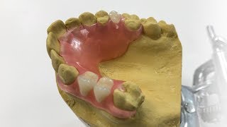 Removable partial denture repairing How to repair a broken partial dentur  Dental Art by Haider [upl. by Ees652]