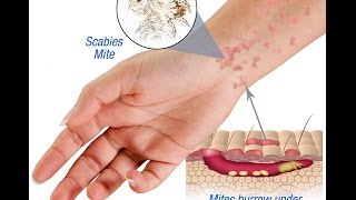 Scabies Causes Symptoms and Treatment [upl. by Imefulo]