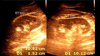 Angiomyolipoma  Renal Mass  Renal Tumor [upl. by Rind140]