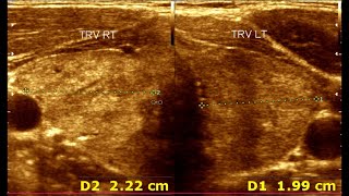 Understanding Ultrasonographic Features of Chronic Thyroiditis [upl. by Nylram202]