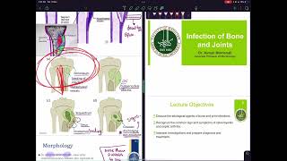 Osteomyelitis pathology amp microbiology [upl. by Sansbury]