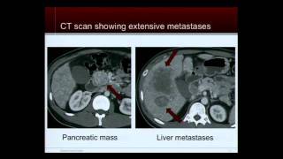 Tumor Board Case Discussions Neuroendocrine Tumor Patient Education Conference [upl. by Amerak]