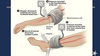 Arteriosclerosis Obliterans Peripheral Vascular Diseases [upl. by Brackely779]