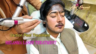 melasma laser treatment Carbon Peel Laser  4k video [upl. by Hars78]