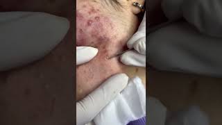 Best Pimple Popping 08 beautiful blackheads sacdepspa [upl. by Adnawat4]