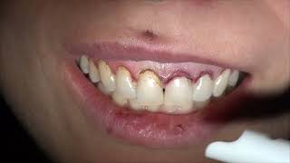 Gingivectomy for aesthetic purpose Cosmetic Dentistry Los Angeles  8187760055 [upl. by Livi]