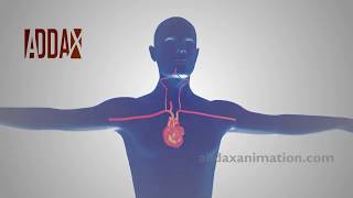 subclavian steal syndrome angiography animation [upl. by Seys]