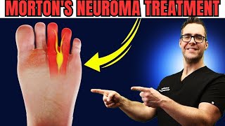 Numbness or Tingling in the Feet or Toes Mortons Neuroma Treatment [upl. by Spillar]