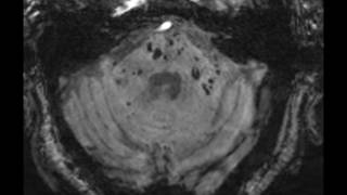 Multiple Cavernoma Syndrome [upl. by Anaxor]