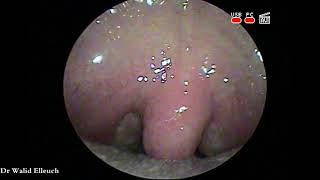 Bacterial tonsillitis sore throat  تعفن لوزات الحلق [upl. by Chute]