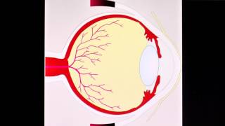 Diabetische Retinopathie [upl. by Monahan478]