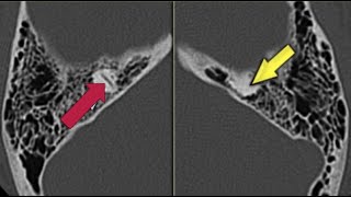 Petrous Spotters  Temporal lesions radiology15 cases in 15 minutes radio tipsandtricks tricks [upl. by Ahsitruc]