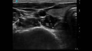 Ultrasound Guided Stellate Ganglion Block [upl. by Ire]