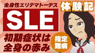 【SLE（全身性エリテマトーデス）】罹患者の9割が女性！赤み・皮膚のかゆさの症状が…！ [upl. by Berenice280]