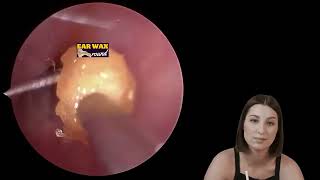 How to remove ear how to remove ear wax murine ear wax removal system how to use murine ear wax [upl. by Field]