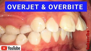 Overjet amp Overbite  Causes amp Treatment Using Braces amp Invisalign [upl. by Naujik]