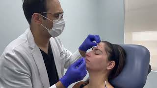 Using Dysport and Sculptra to treat facial and eyebrow asymmetry by Dr Shaun Patel in Miami FL [upl. by Omora]